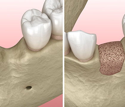インプラントセミナー 骨造成について